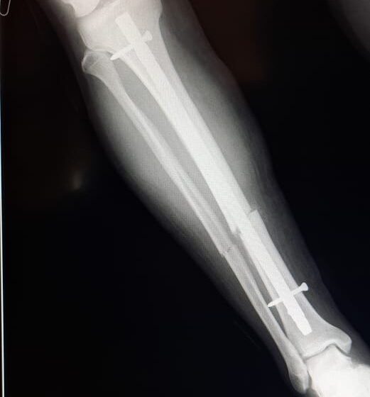  Se efectuó importante intervención quirúrgica en el Hospital Subzonal de El Maitén